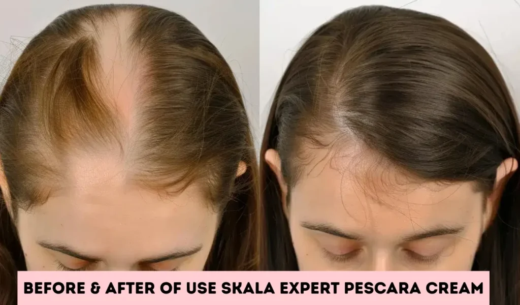 Before & After of use Skala Expert Pescara Cream